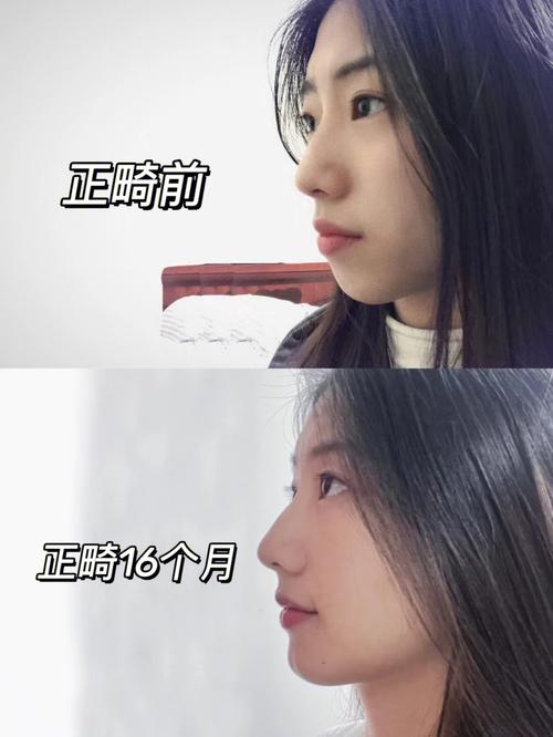 格莱美牙齿矫正效果如何？体验好不好？真实口碑怎么样？-图2