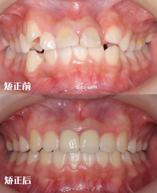 牙齿前突矫正图片对比，前后变化到底有多明显？-图1