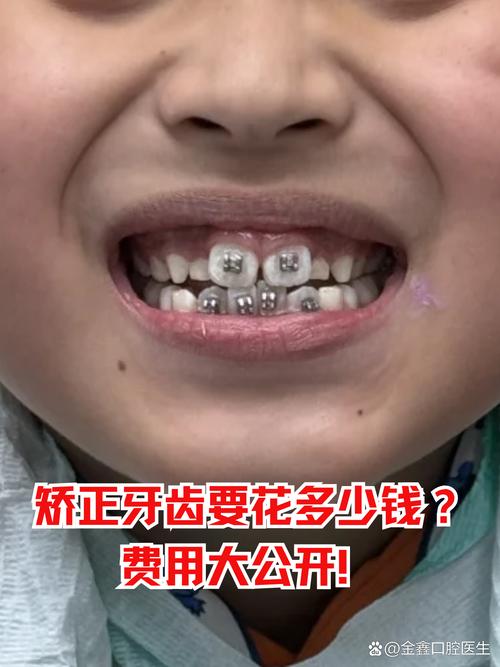 想做牙齿矫正没钱咋办-图1