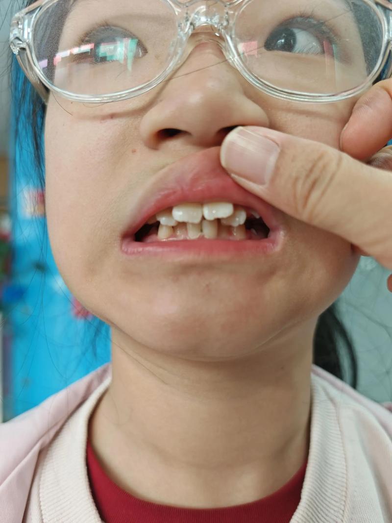 刚矫正牙齿吃不了东西，这是怎么回事？-图2
