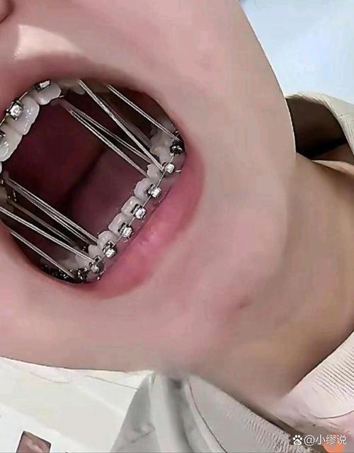 刚矫正牙齿吃不了东西，这是怎么回事？-图1