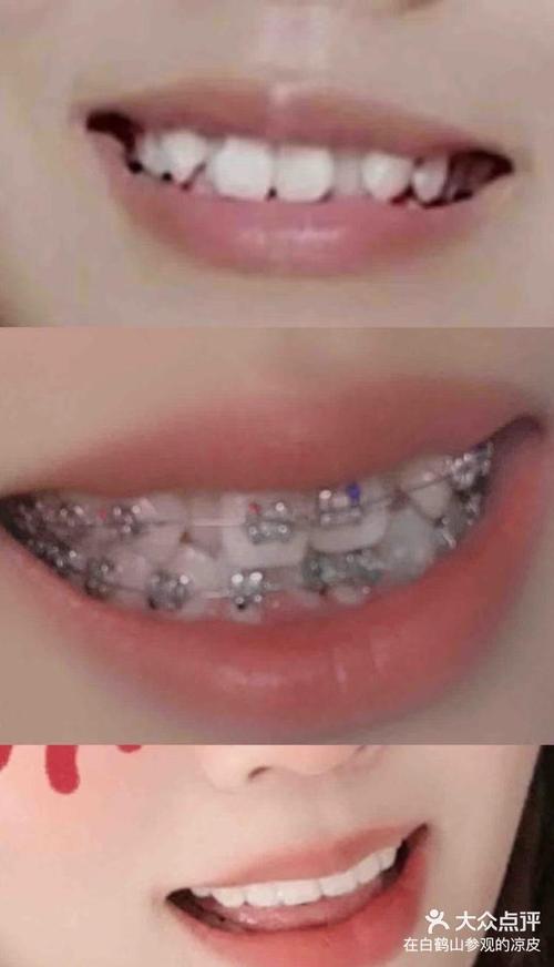 刚矫正牙齿吃不了东西，这是怎么回事？-图3