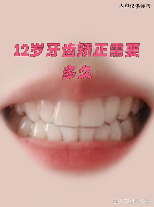 12岁牙齿矫正一般需要多久？-图1