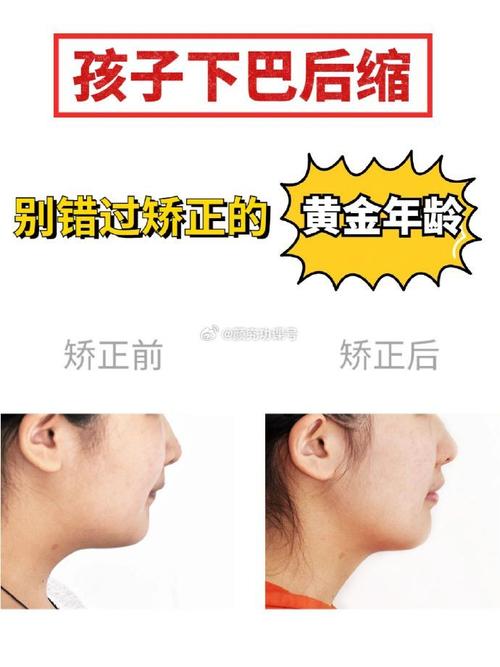 矫正牙齿改善下巴后缩-图2