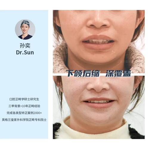 矫正牙齿改善下巴后缩-图1
