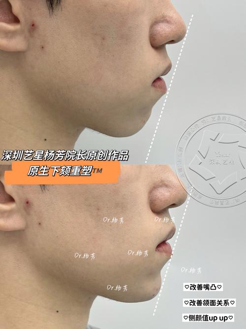 矫正牙齿改善下巴后缩-图3
