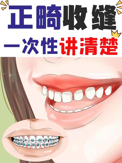 牙齿矫正牙缝怎么收？医生常用的收缝方法有哪些？-图1