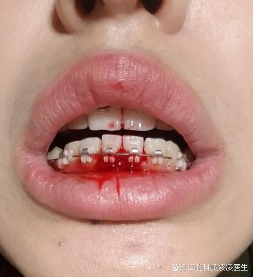 牙齿矫正期间牙龈出血-图2 牙齿矫正期间牙龈出血-图2