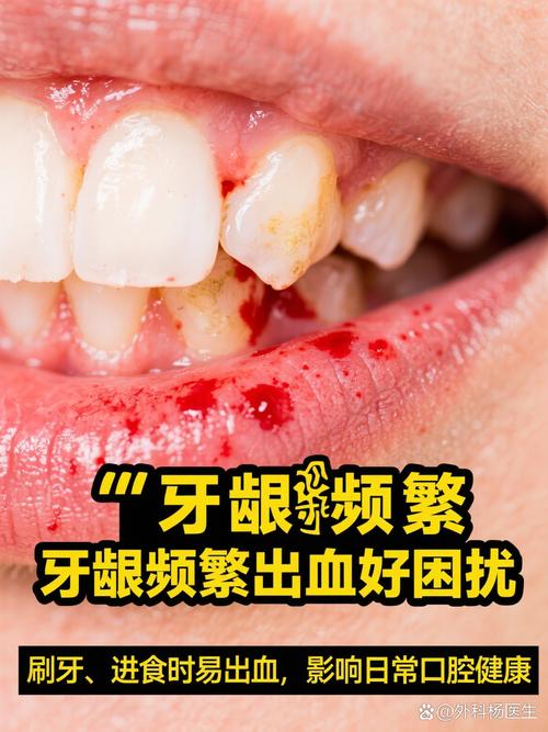牙齿矫正期间牙龈出血-图1 牙齿矫正期间牙龈出血-图1