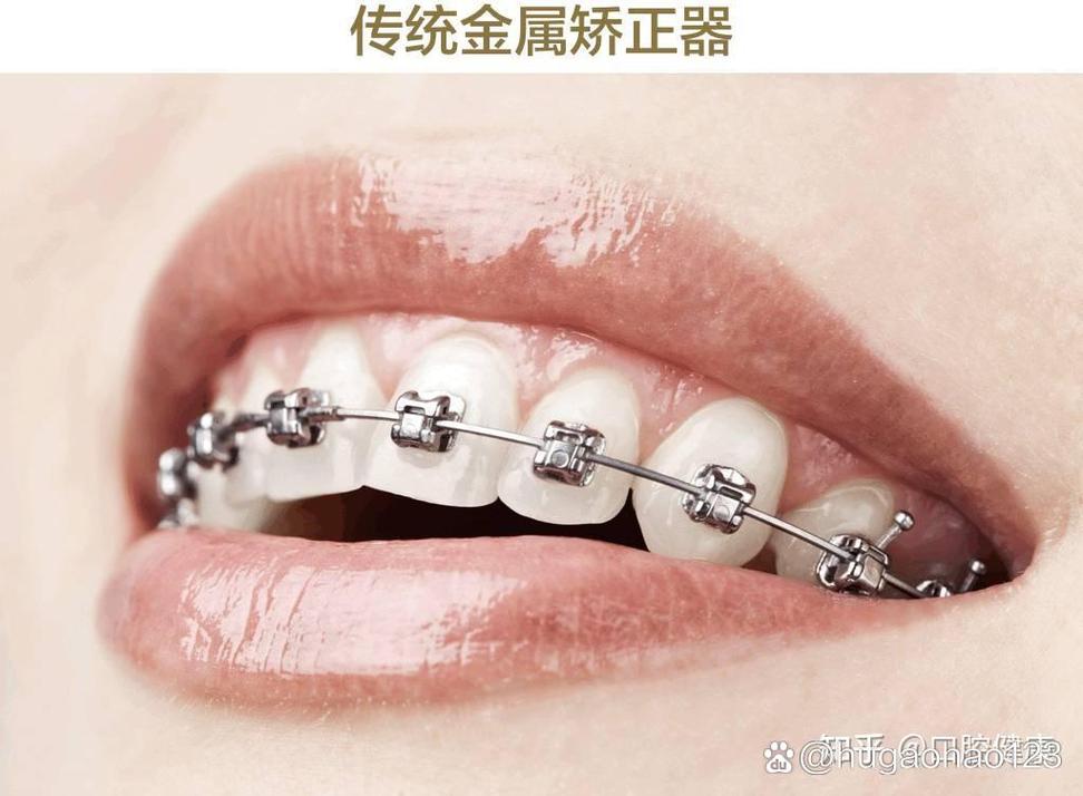 保定牙齿矫正去哪家好？靠谱机构怎么选？-图2