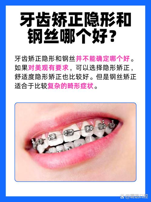 隐形牙齿矫正医院有吗？哪家医院能做隐形矫正？-图1