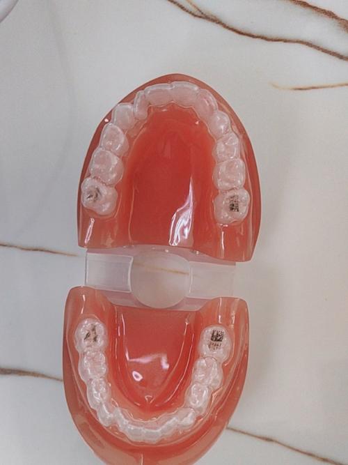 矫正牙齿后，保持器有哪些常见类型？-图2