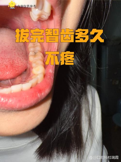拔牙后矫正牙齿一般需要间隔多长时间才能开始矫正呢?-图2 拔牙后矫正牙齿一般需要间隔多长时间才能开始矫正呢?-图2