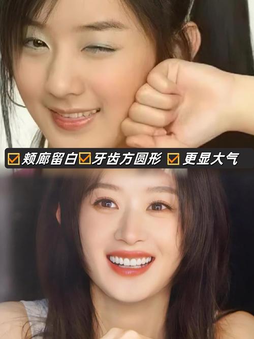 明星为何高龄矫正牙齿？晚矫正效果如何？-图1