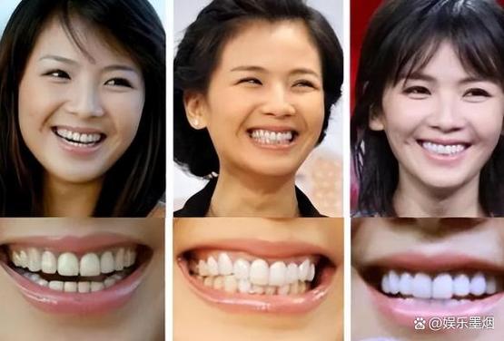 明星为何高龄矫正牙齿？晚矫正效果如何？-图3