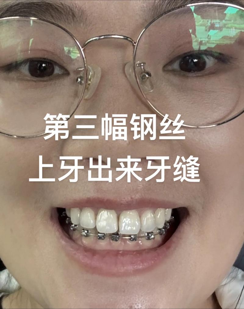 矫正牙齿反弹后牙缝变大，是什么原因造成的呢？该怎么处理？-图2