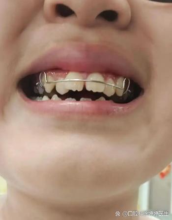 不用牙套如何快速矫正牙齿？-图3