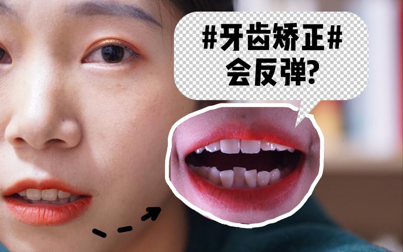 牙齿矫正后反弹的图片,如何判断反弹原因?预防方法有哪些?-图1 牙齿矫正后反弹的图片,如何判断反弹原因?预防方法有哪些?-图1