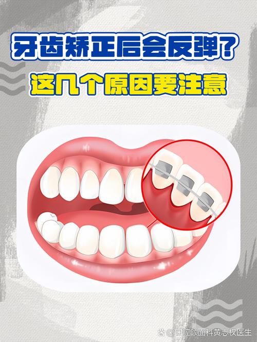 牙齿矫正后反弹的图片,如何判断反弹原因?预防方法有哪些?-图3 牙齿矫正后反弹的图片,如何判断反弹原因?预防方法有哪些?-图3