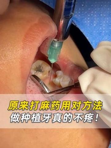 矫正牙齿打麻药会疼吗?-图2 矫正牙齿打麻药会疼吗?-图2