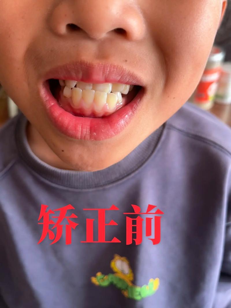 半隐形牙齿矫正对地包天的矫正效果怎么样？-图1