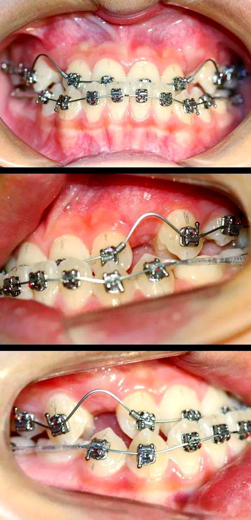 半隐形牙齿矫正对地包天的矫正效果怎么样？-图3