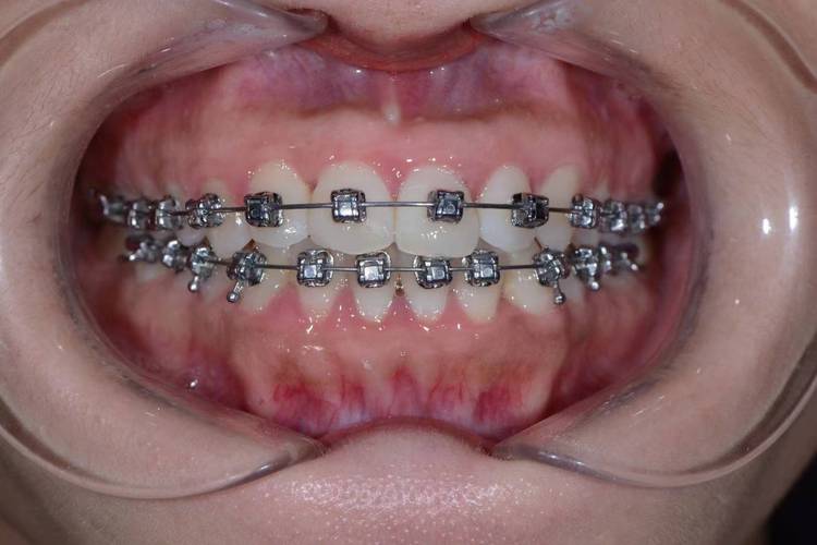 矫正牙齿选医院？关键看资质与方案适配性-图3