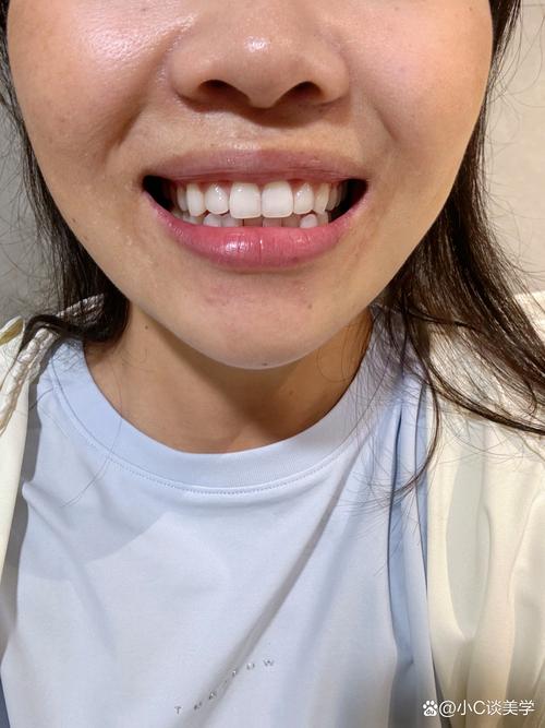 不做矫正就做维持？牙齿矫正与维持的顺序能省吗？-图2