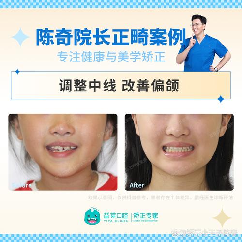 牙齿轻度拥挤矫正一般需要多长时间？-图1