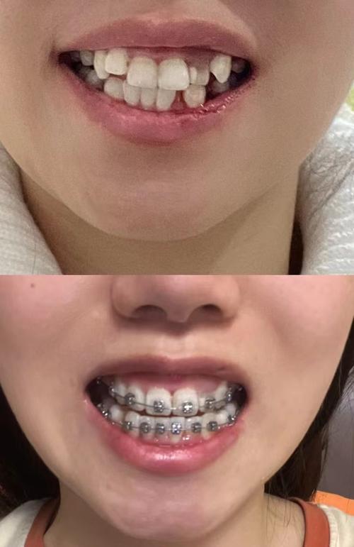 矫正牙齿期间牙缝变大是正常现象吗？-图1