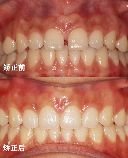 矫正牙齿期间牙缝变大是正常现象吗？-图3