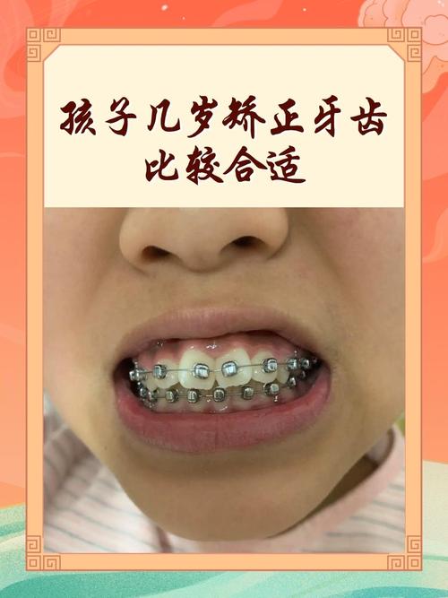 孩子多大适合牙齿矫正-图1 孩子多大适合牙齿矫正-图1