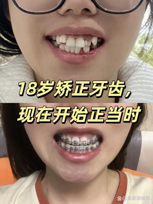 长春哪里牙齿矫正便宜又靠谱？-图2