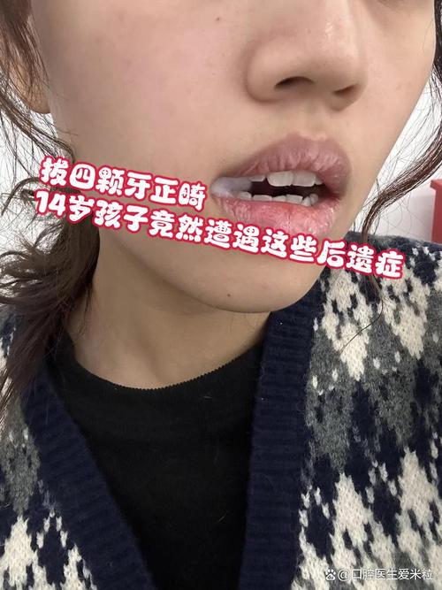 矫正拔牙后留缝隙怎么办？会自行关闭吗？-图1