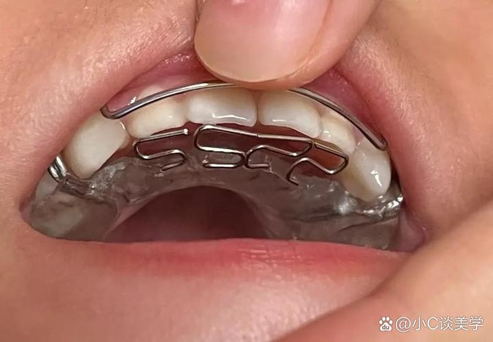 牙齿重叠错位矫正图片能展示矫正前后对比效果吗？-图3