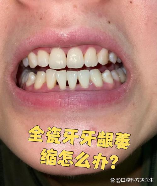矫正牙齿导致牙龈萎缩？如何应对？-图2