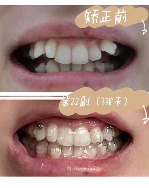 哪些牙齿情况适合隐形矫正？-图2