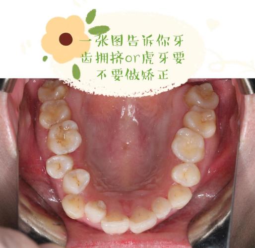 矫正牙齿拔了虎牙后悔-图2