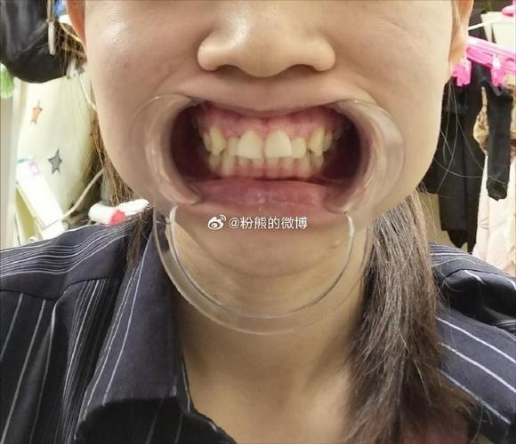 矫正牙齿拔了虎牙后悔-图3