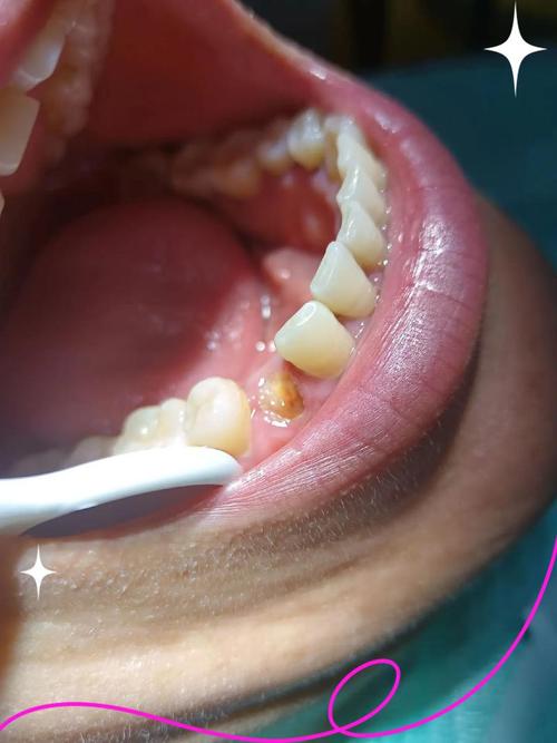 牙齿矫正后牙根出来了，是什么原因导致的？该如何处理？-图3