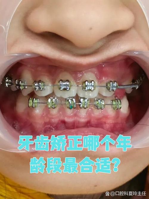 龙岩矫正牙齿哪里最好？专业机构怎么选？-图1