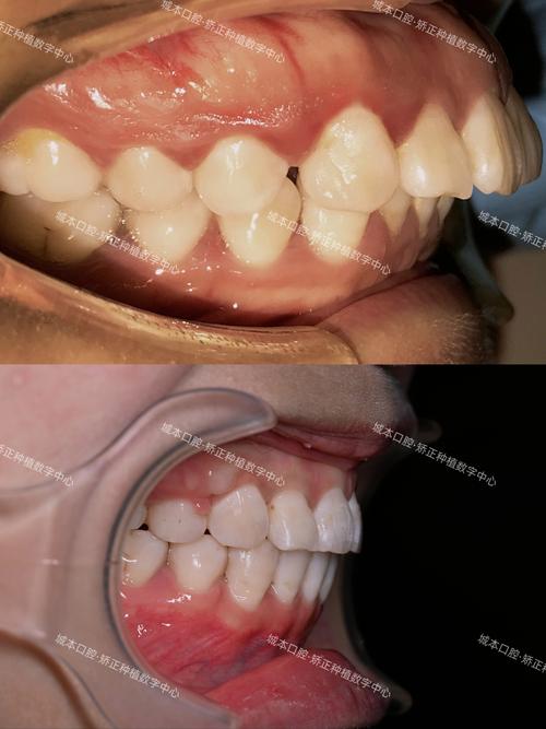 上颌发育过度牙齿矫正-图2