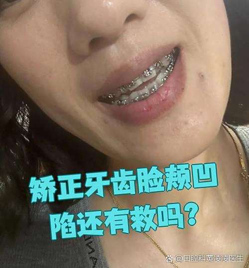 牙齿矫正后脸颊凹陷正常吗？图片解析原因与改善方法-图2