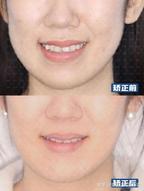 牙齿矫正后脸颊凹陷正常吗？图片解析原因与改善方法-图1