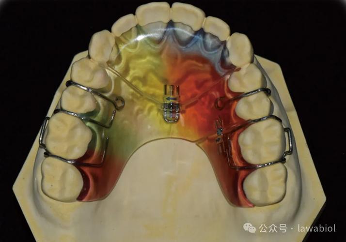 杭州专业口腔牙齿矫正，如何选择靠谱机构与矫正方案？-图3
