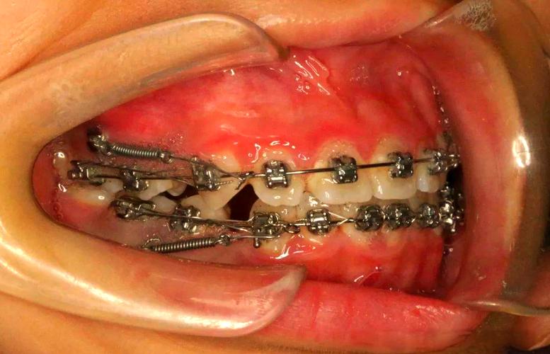 种植前为何必须矫正牙齿？矫正对种植的关键作用是什么？-图3