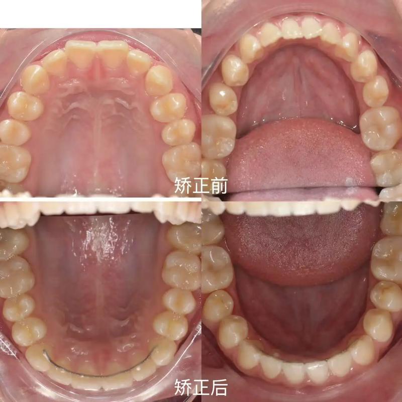 上海矫正牙齿排列不齐，哪种方法更合适？-图1