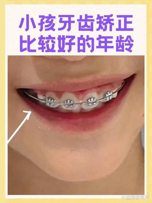 小孩矫正牙齿的最佳年龄是几岁？-图2