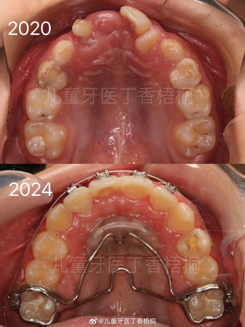 儿童矫正牙齿,为什么有时需要拔牙?-图3 儿童矫正牙齿,为什么有时需要拔牙?-图3
