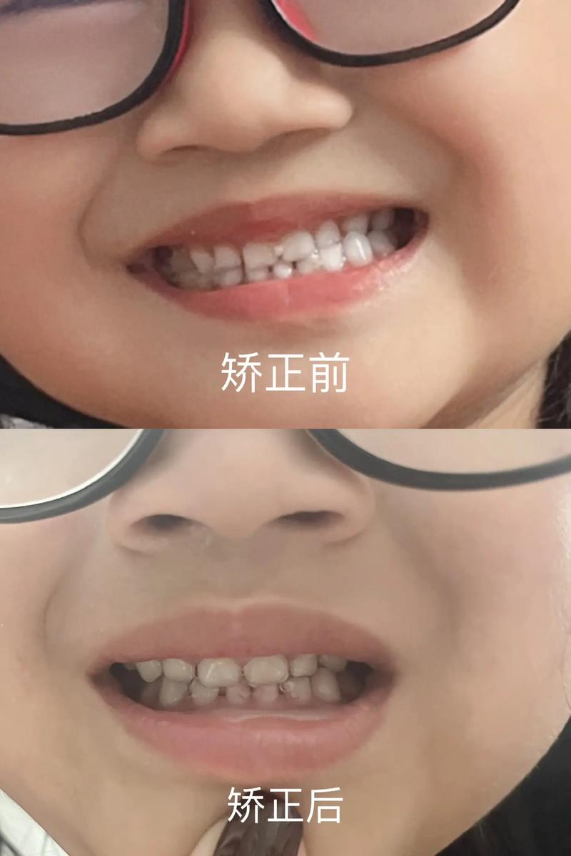 湖州矫正牙齿哪里最好？求本地靠谱诊所推荐！-图2